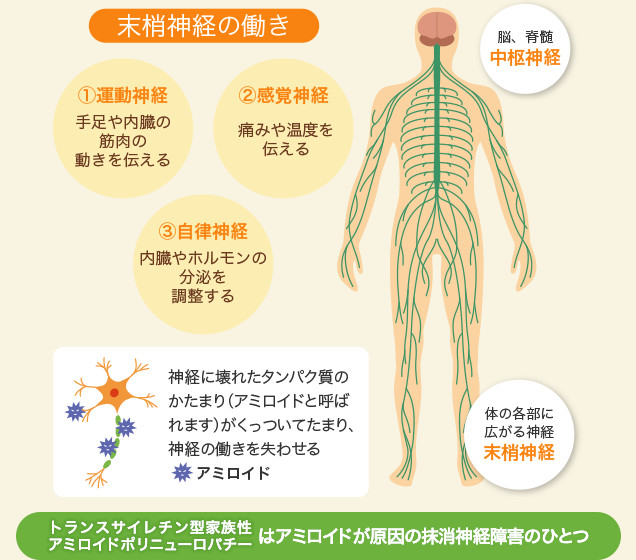 トランスサイレチン型家族性アミロイドポリニューロパチーはアミロイドが原因の末梢神経障害のひとつです。